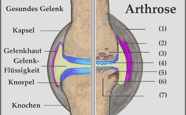 Arthrose: Knacken, knirschen, leiden